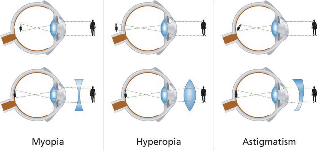 hyperopia myopia asztigmatizmus látásélesség)