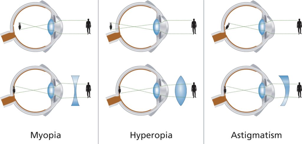 myopia hyperopia asztigmatizmus)