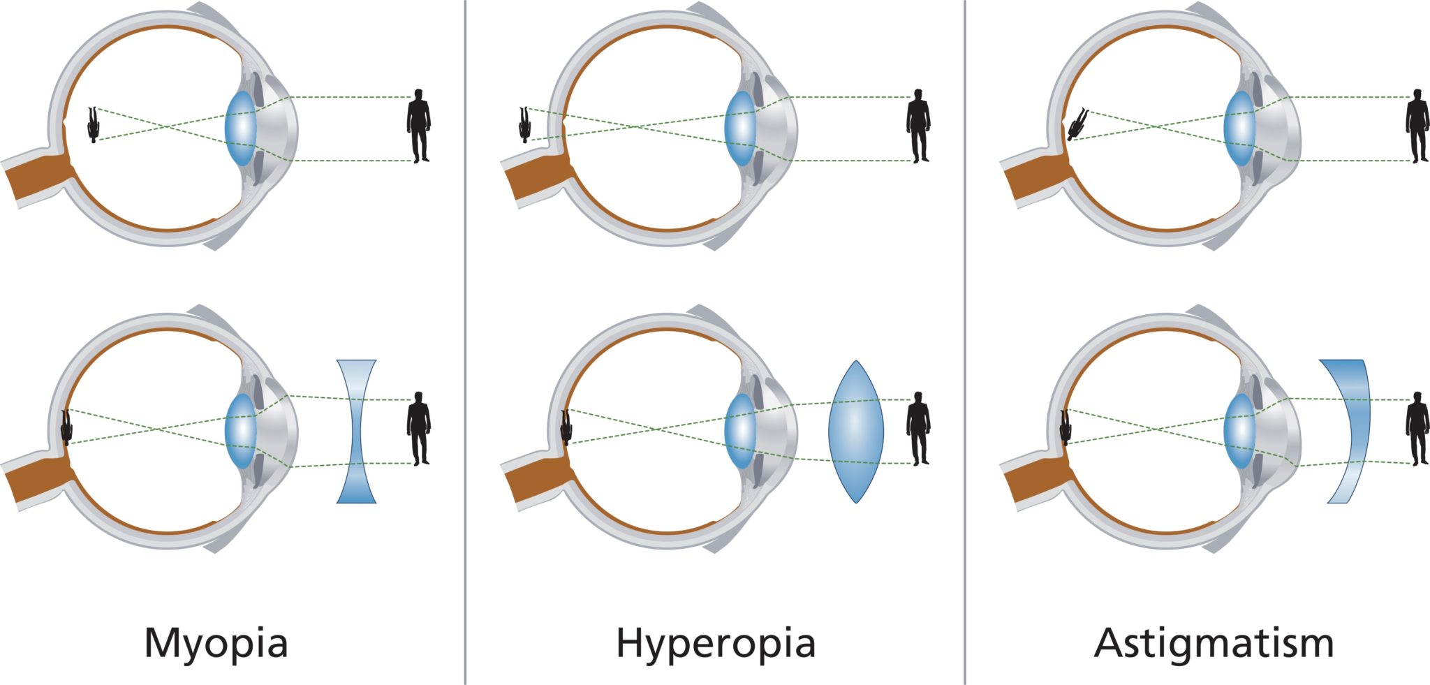 astigmatism myopia hyperopia