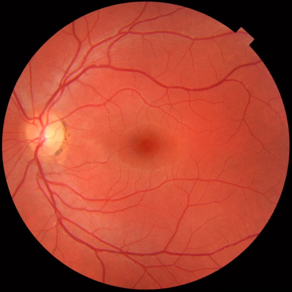 retinal-exams-new-optix-optometry